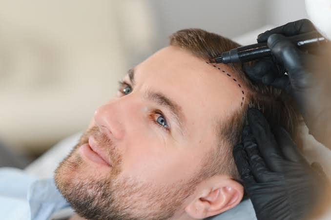 FUE Hair Transplantation in Minsk: How a State Clinic is Filling a Niche Previously Served Only Abroad