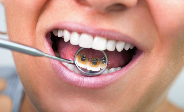 Здоровые и красивые зубы с помощью брекетов