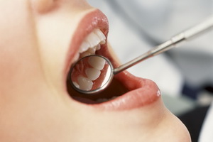 Гингивит, лечение, симптомы, стоматологи, подвижность зубов, формы гингивита