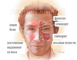 Другие заболевания, которые сопровождаются гнойными выделениями из носа