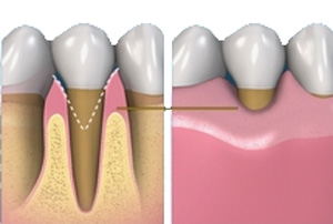 лечение клиновидного дефекта зубов,  чувствительность зубов